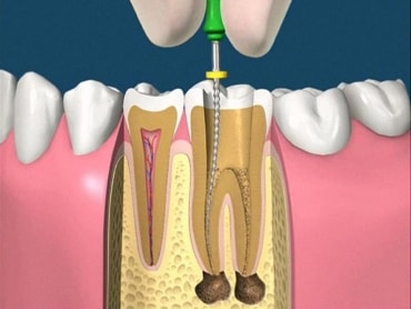 Endodonzia